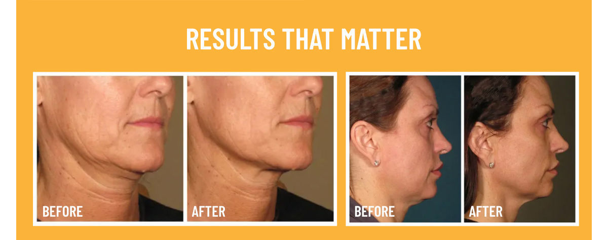 Ultherapy results